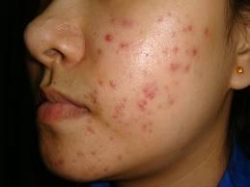 How to effectively treat your acne scars?