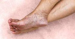 Chronic Venous Insufficiency Test