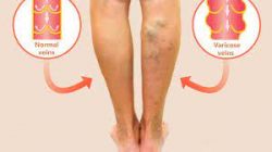 What is the best method of varicose veins treatment?  