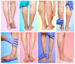 Looking for varicose vein treatment in Houston?