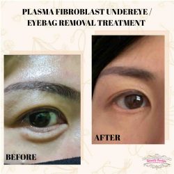 Procedure Of Eye Bag Removal