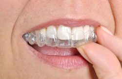 Invisalign Dentist Near You