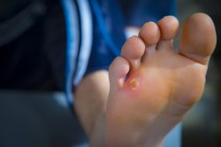 Ingrown toenails treatment