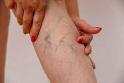 Harvard Trained Vein Doctor | The Vein Center in LI Answers FAQs | Vein Treatment Center