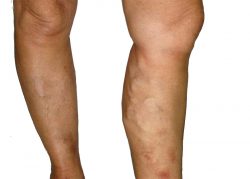 Harvard Trained Vein Doctor | Should I get laser treatment for spider veins?