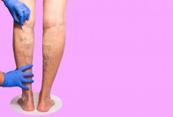 Harvard Trained Vein Doctors | Average Cost of Varicose Vein Treatment New Jersey