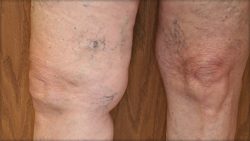 What Does Varicose Vein Pain Feel Like? | Advice from Harvard Vein Pain Doctors