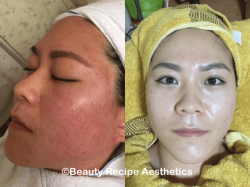 Deep Cleansing Facial With Advance Technique