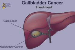 Gallbladder Cancer Treatment in Mumbai