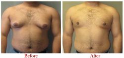 Best Gynecomastia Surgeon in Delhi | Dr. Vivek Kumar