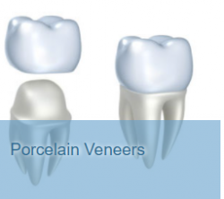 Porcelain Veneer San Diego – The Gentle Dentistry