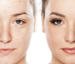 Effectual & Worthwhile Skin Disease Ayurvedic Treatment