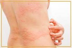 Get Finest Urticaria Ayurvedic Treatment at Prakash Ayurveda