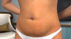 Tummy Tuck Surgery Cost in Jaipur