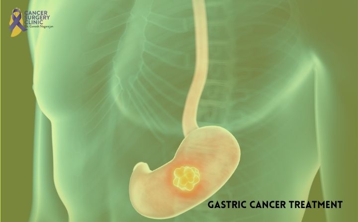 Top Gastric Cancer Treatment Clinic in Mumbai