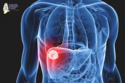 Liver Cancer Treatment in Mumbai