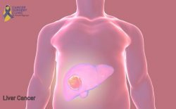 Liver Cancer Treatment Doctor Mumbai