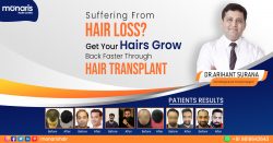 Hair Transplant in Delhi