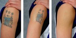 17 Things Every Person Should Know about Laser Tattoo Removal.