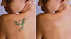 17 Things Every Person Should Know about Laser Tattoo Removal.