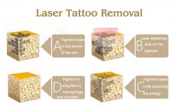 Laser Tattoo Removal