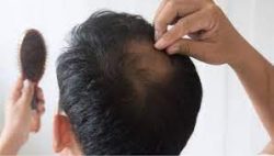 Scalp Micropigmentation For Thinning Hair