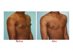 Best Gynecomastia Surgeon in Delhi | Dr. Vivek Kumar