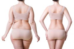 Liposuction procedure in Delhi | Dr Rajat Gupta