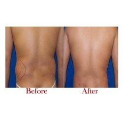 Best Liposuction Surgeon in India | Dr. Vivek Kumar