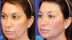 Cheek enhancement fillers Treatment