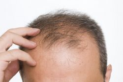 Hair Loss Treatment in Delhi