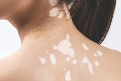 Vitiligo Can Be Treated Efficiently By The Best Dermatologist In Delhi