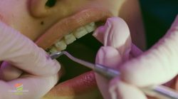 Best Braces Treatment in Gurgaon