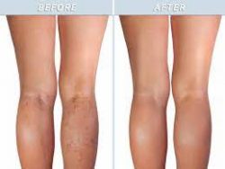 Spider Vein Removal | Bared Monkey Laser Spa