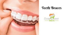 Teeth Braces Cost in Delhi