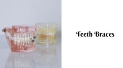 Cosmodent India Teeth Braces Cost in India