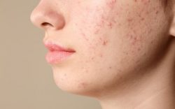 Experienced acne specialist in South Delhi