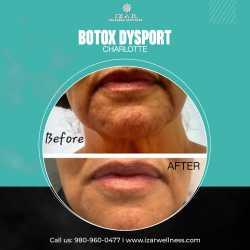 Botox Dysport Charlotte