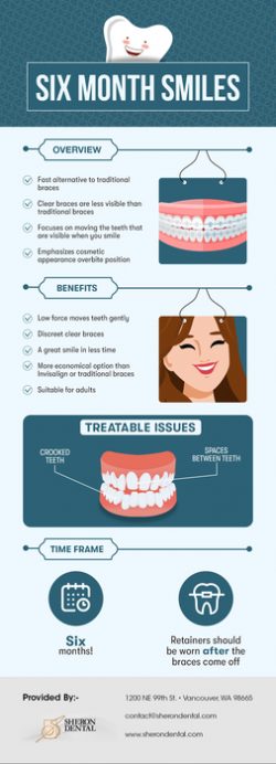 Choose Sheron Dental for Six Month Smiles in Vancouver, WA