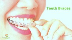 Cosmodent India For Teeth Braces Cost in India