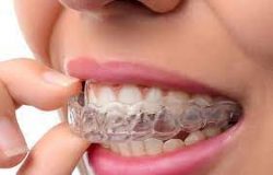 Invisalign Specialist Near Me | Invisalign Cost Texas | Invisalign Treatment