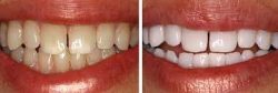 Professional Teeth Whitening Dentist Near Me | Teeth Whitening Houston