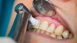 How Often Should you Get Teeth Cleanings? | The Dentist Houston