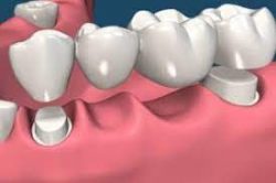 Dental Bridges – Types & Cost of Dental Bridges Houston