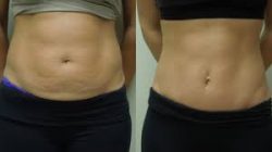 What Is Involved in Tummy Tuck Surgery?