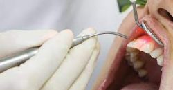 Laser Gingivectomy Treatment Near Me