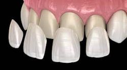 Porcelain Veneers Near Me | Temporary Veneers Vs No Prep Veneers