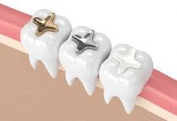 Tooth Filling Near Me | Types of Dental Fillings | Ceramic Fillings