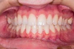 Preparing for a Crown Restoration – Emergency Dentist In Houston