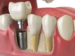 Invisalign Near Me | Average Cost of Invisalign Houston